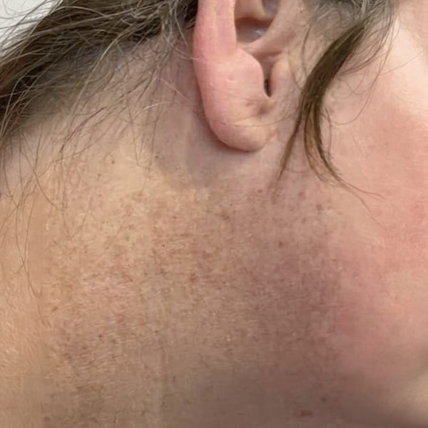 DermaPatches - Bli av med hudflikar utan smärta